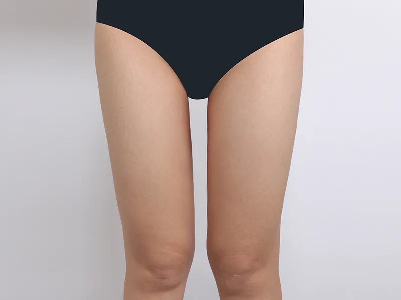 Thigh liposuction after