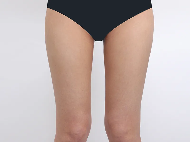 Thigh liposuction after
