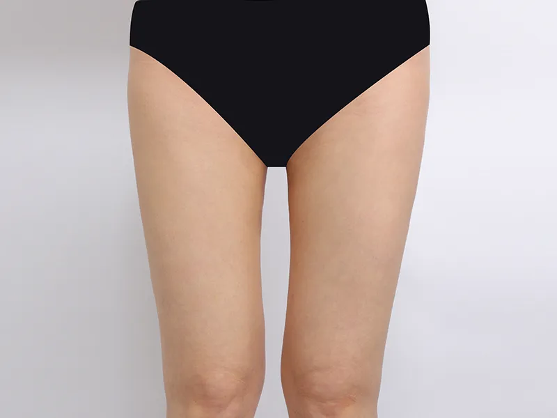 Thigh liposuction after