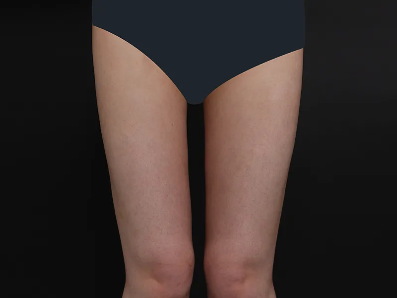 Thigh liposuction after