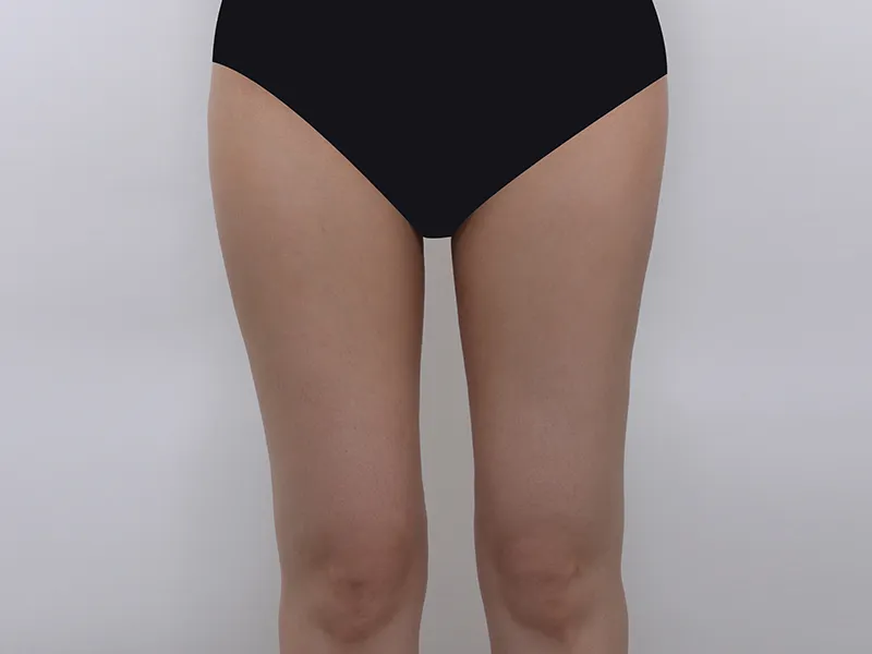 Thigh liposuction after