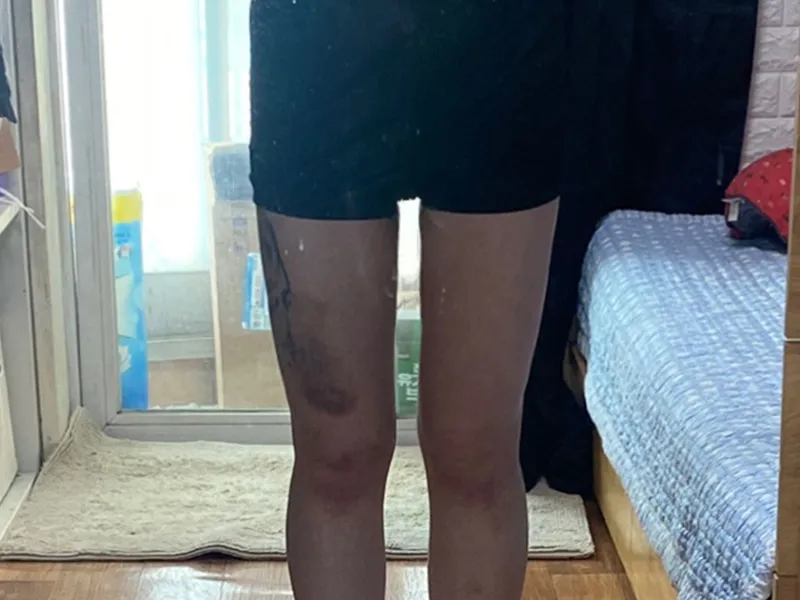 Thigh liposuction after