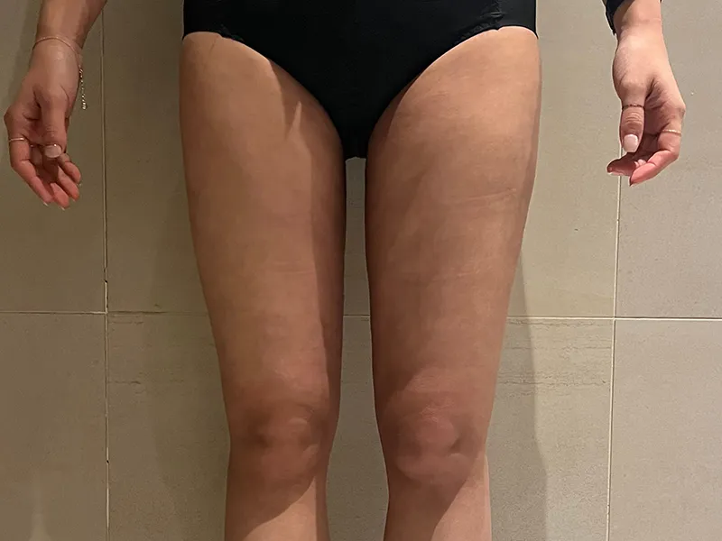 Thigh liposuction after