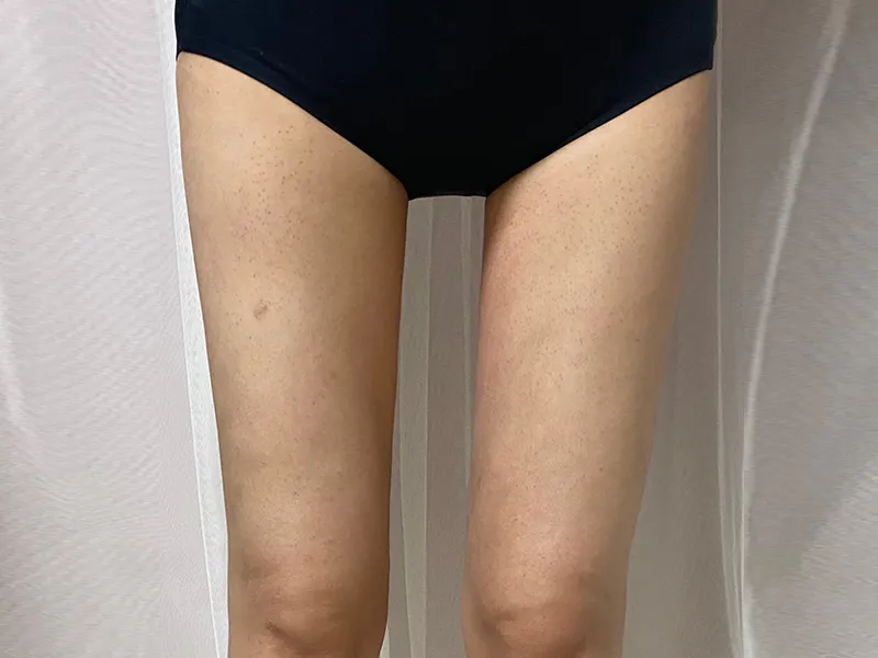 Thigh liposuction after
