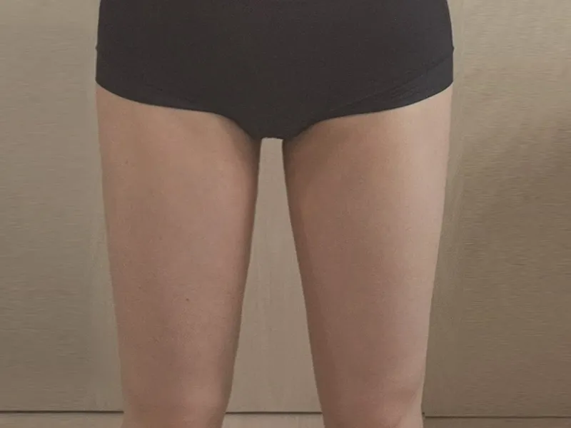 Thigh liposuction after