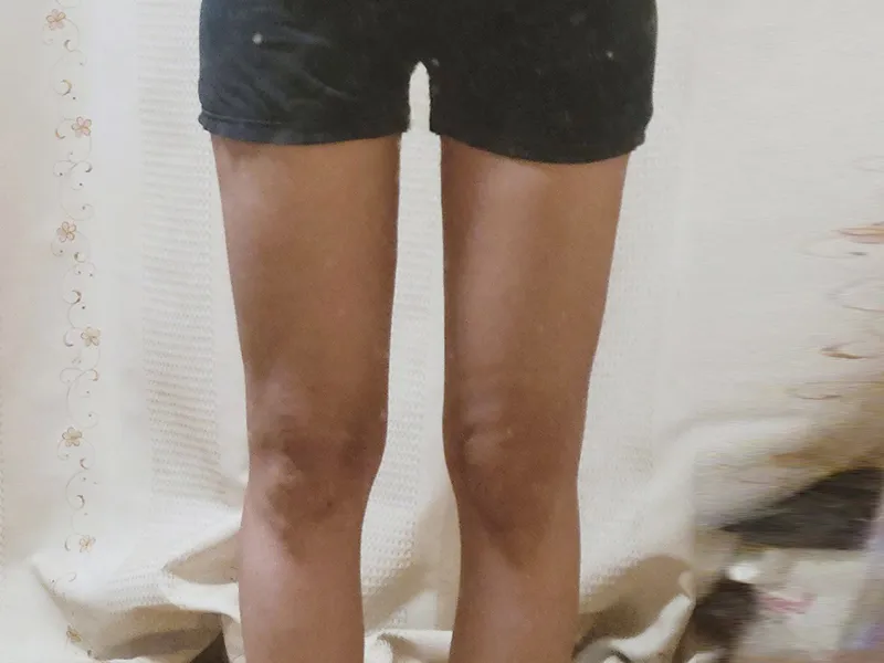 Thigh liposuction after