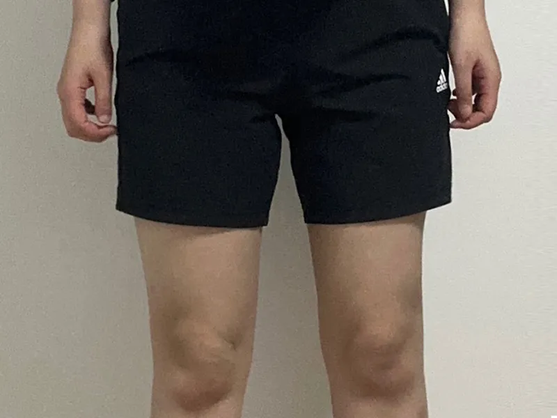 Thigh liposuction after