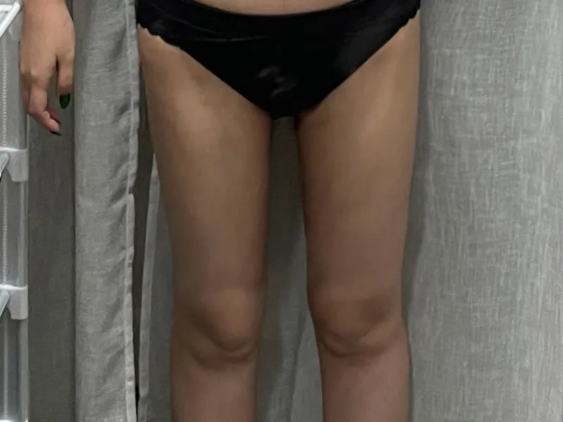 Thigh liposuction after