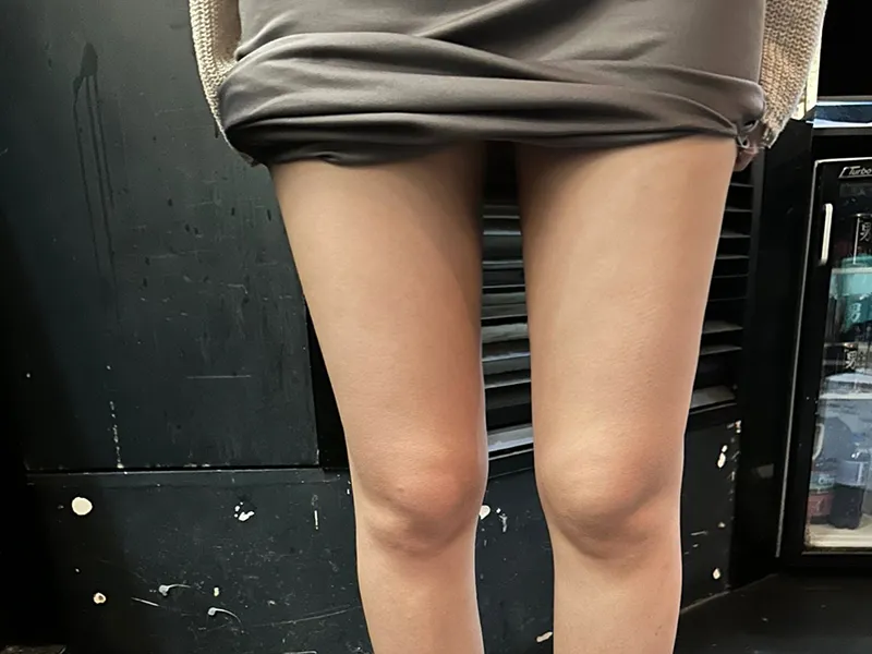 Thigh liposuction after