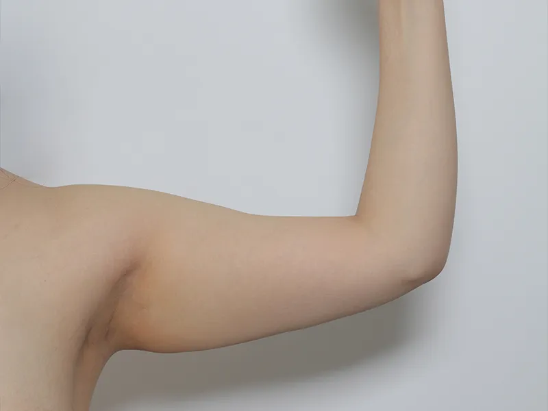Arm liposuction before