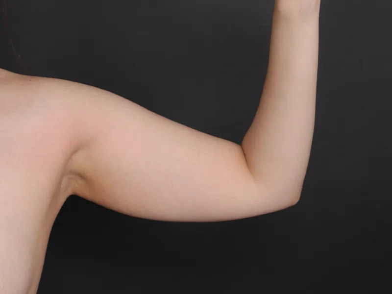 Arm liposuction before