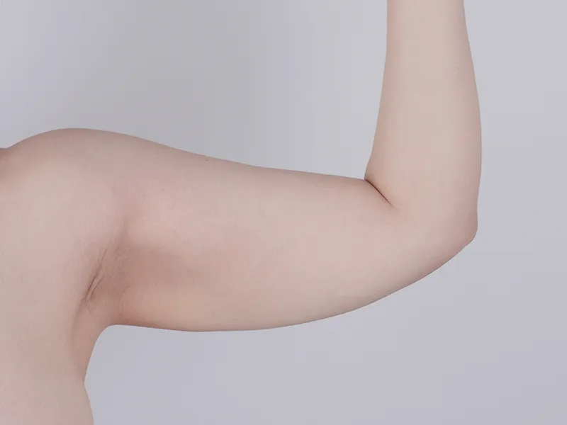 Arm liposuction before