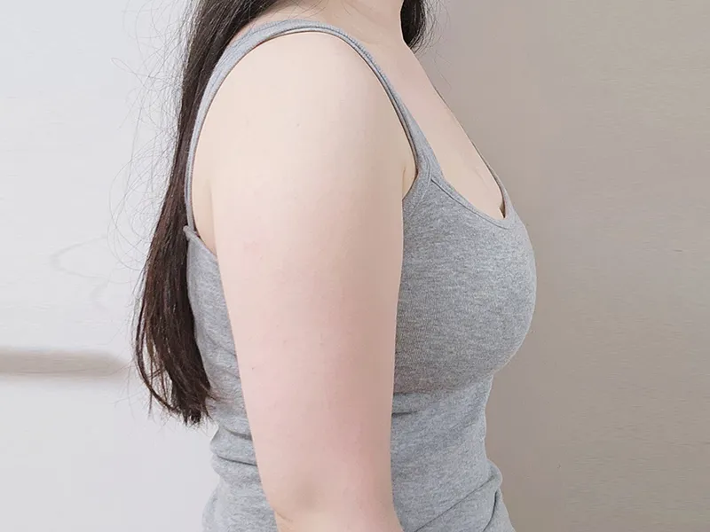 Arm liposuction before