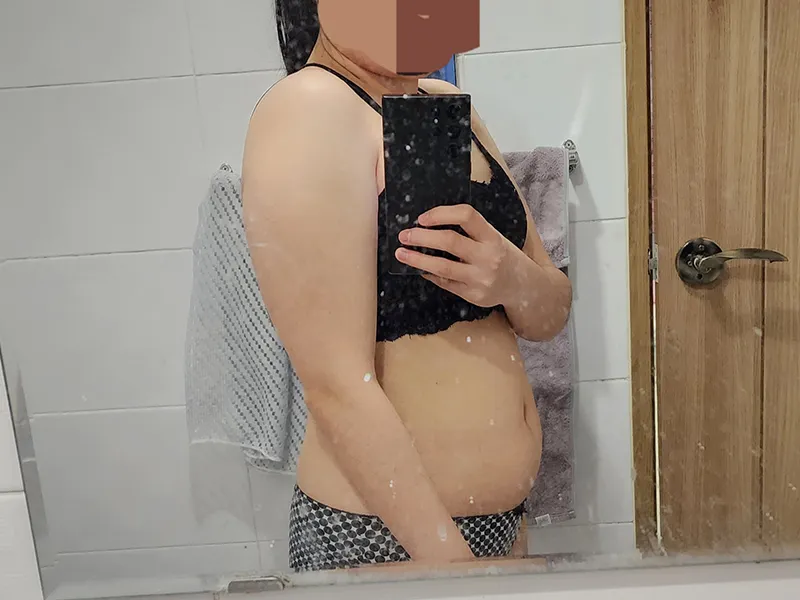 Arm liposuction before