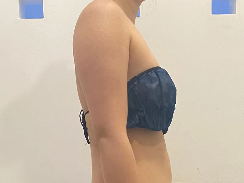 Arm liposuction before