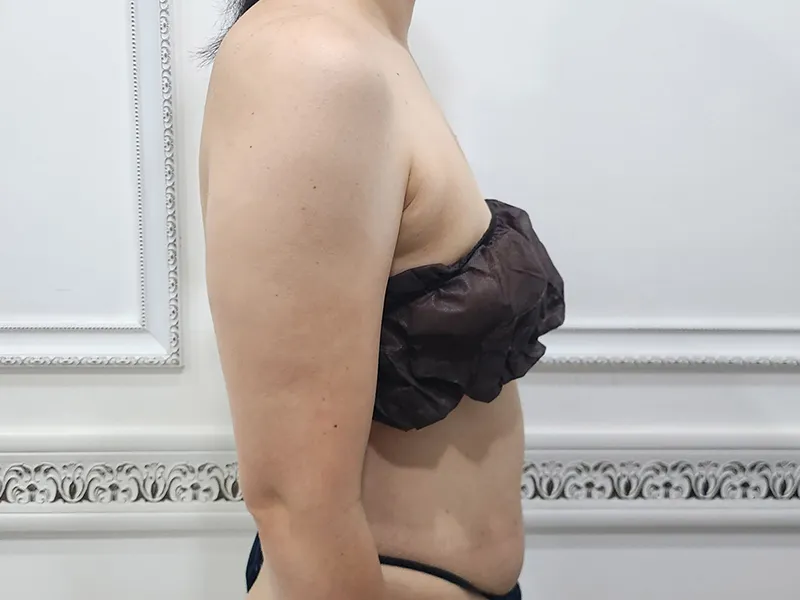 Arm liposuction before