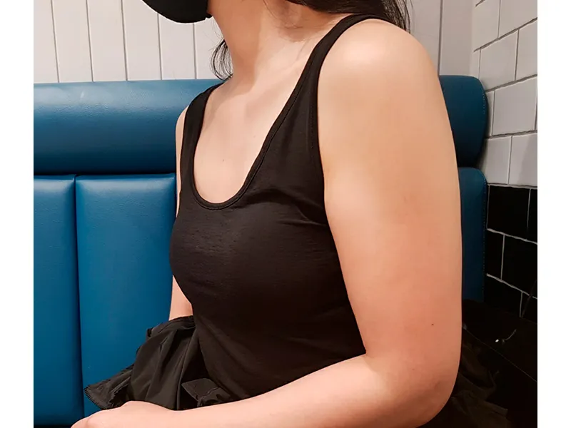Arm liposuction before