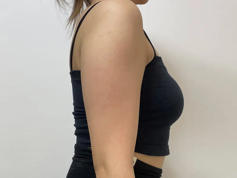 Arm liposuction before