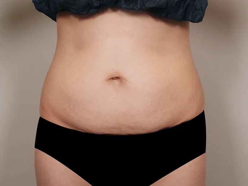 Abdomen liposuction before