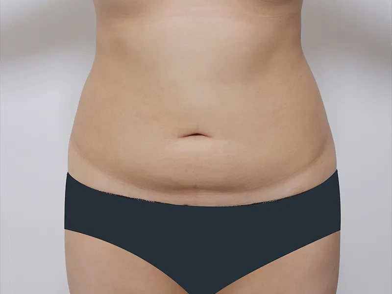 Abdomen before