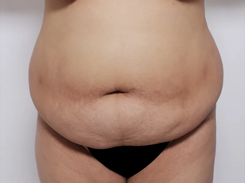 Tummy tuck before
