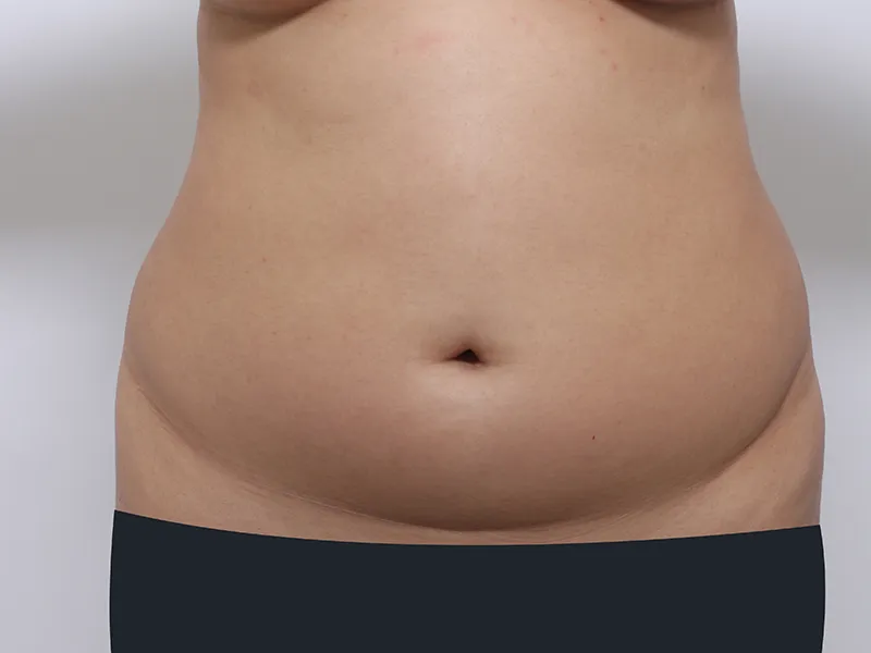 Abdomen liposuction before