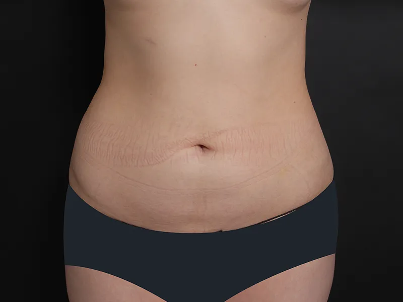 Abdomen liposuction before