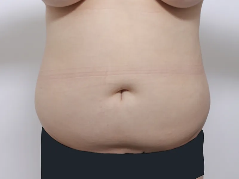 Abdomen liposuction before