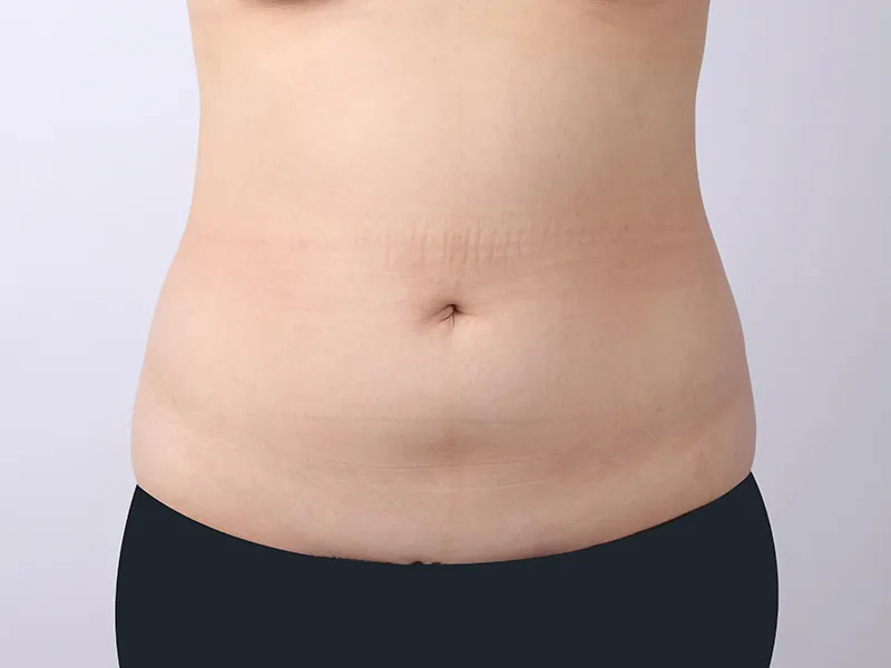 Abdomen liposuction before