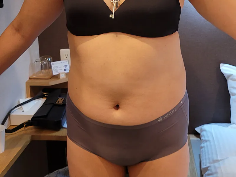 Abdomen liposuction before