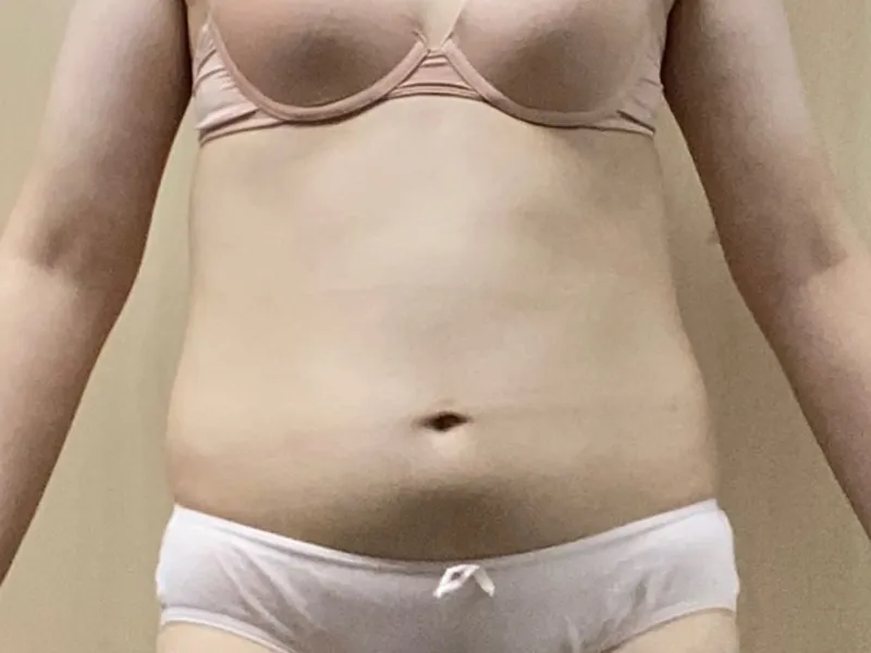 Abdomen liposuction before
