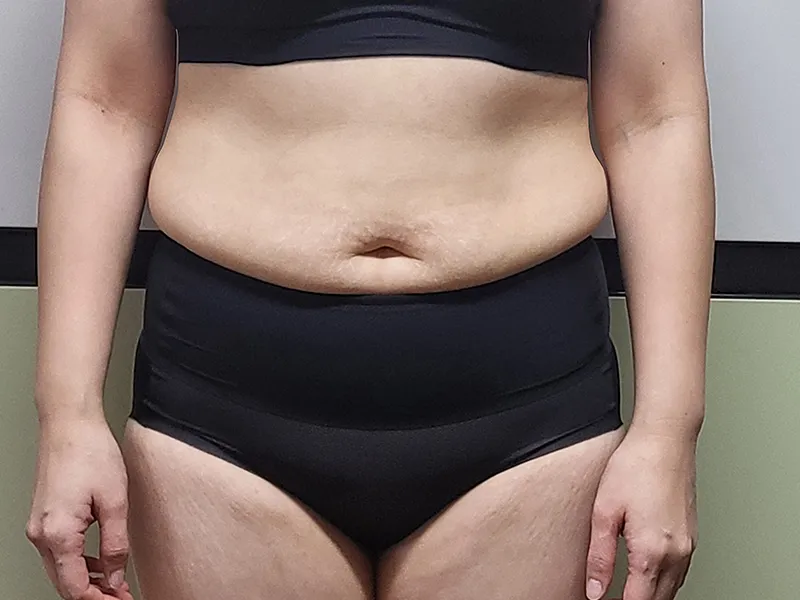 Abdomen liposuction before