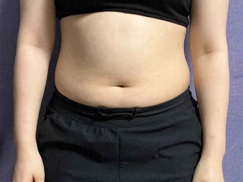 Abdomen liposuction before