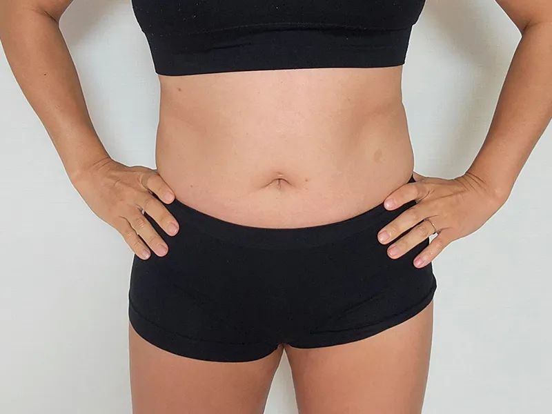 Abdomen liposuction before