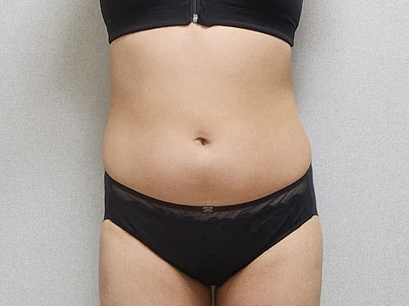 Abdomen liposuction before