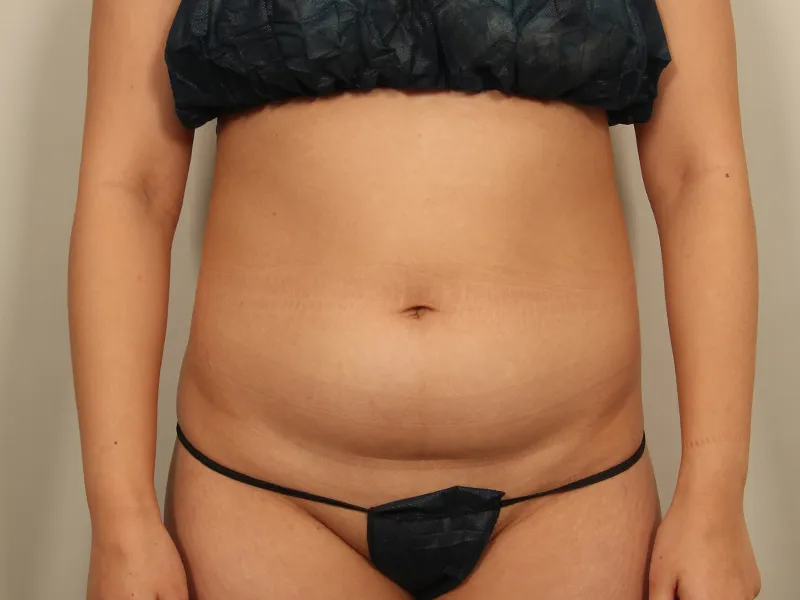 Abdomen liposuction before