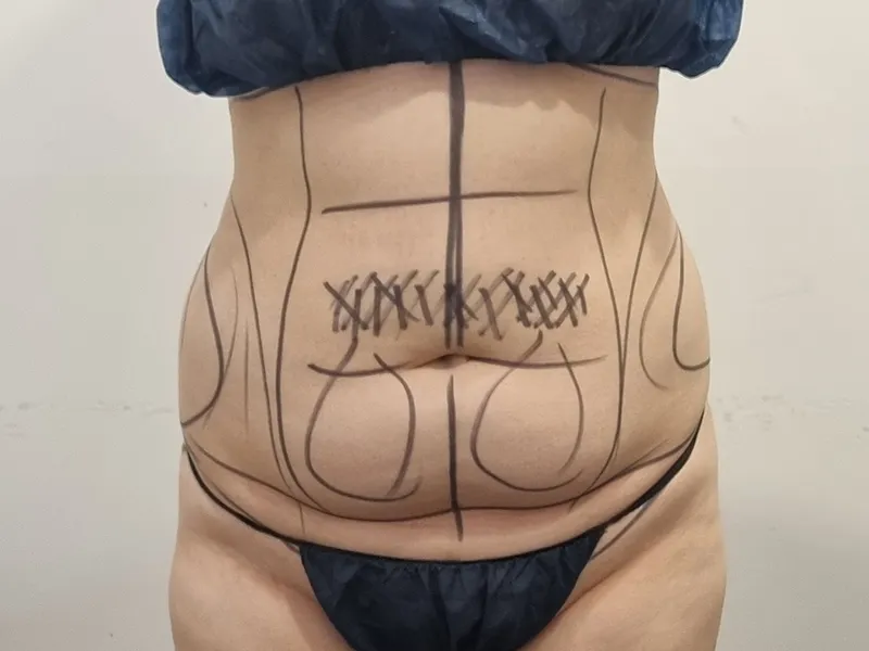 Abdomen liposuction before