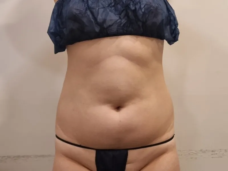 Abdomen liposuction before