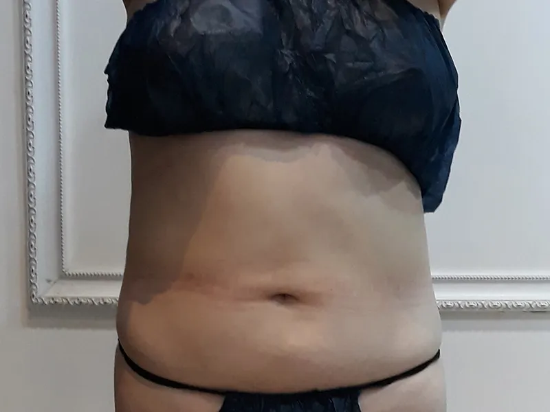 Abdomen liposuction before