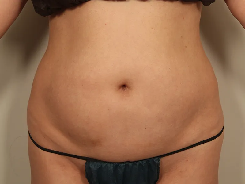 Abdomen liposuction before
