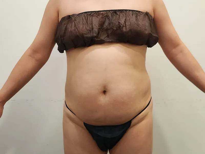 Abdomen liposuction before