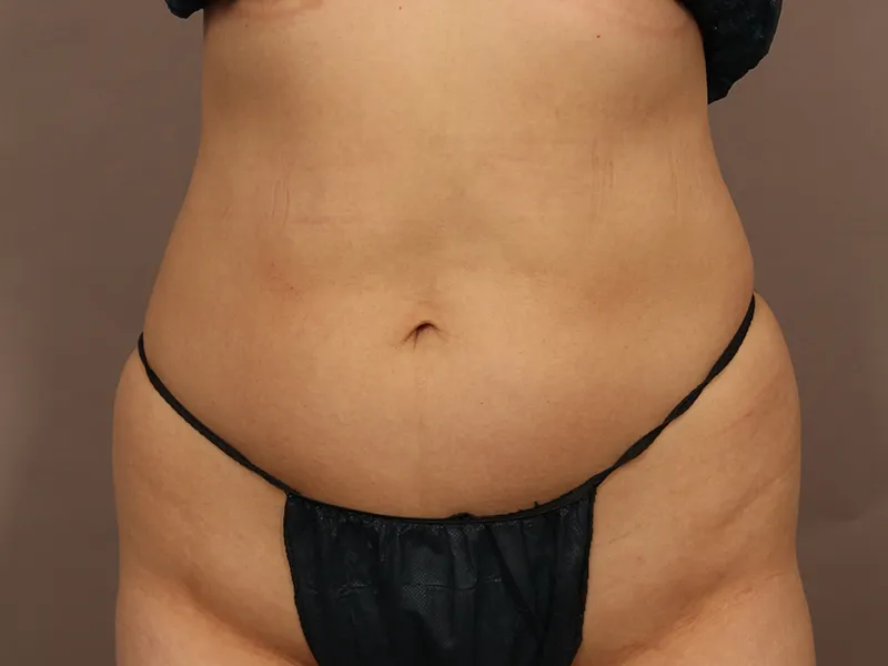 Abdomen liposuction before