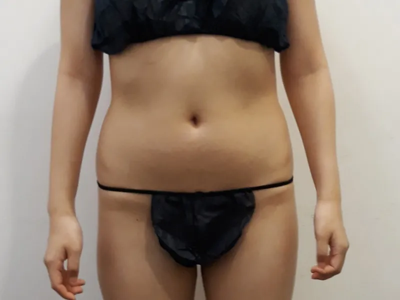 Abdomen liposuction before