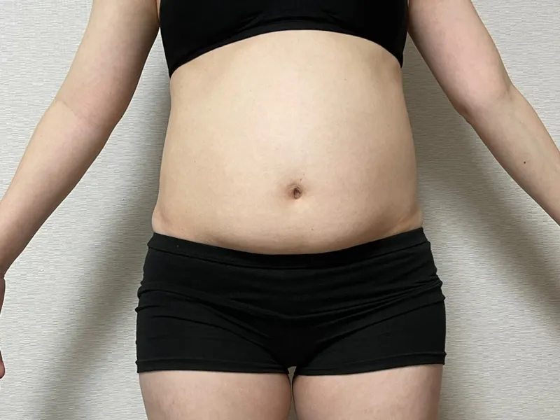 Abdomen liposuction before