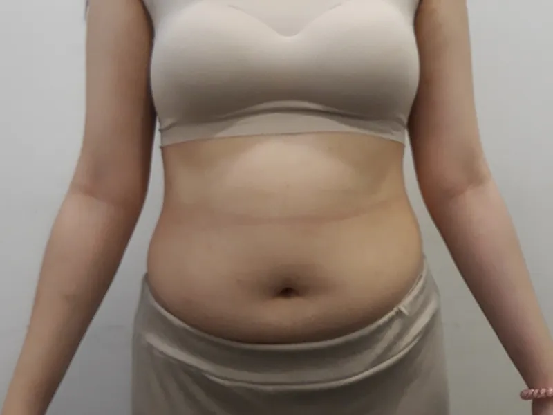 Abdomen liposuction before