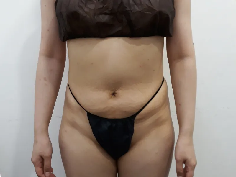 Abdomen liposuction before