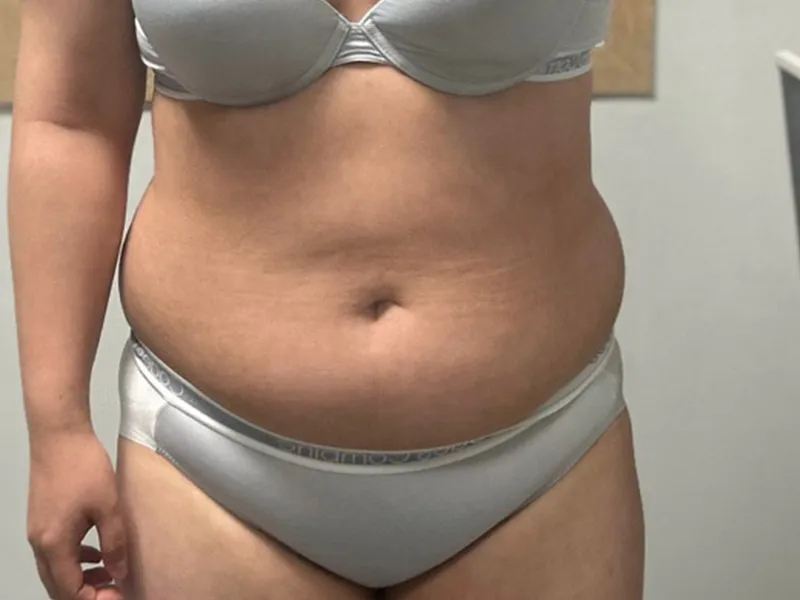 Abdomen liposuction before