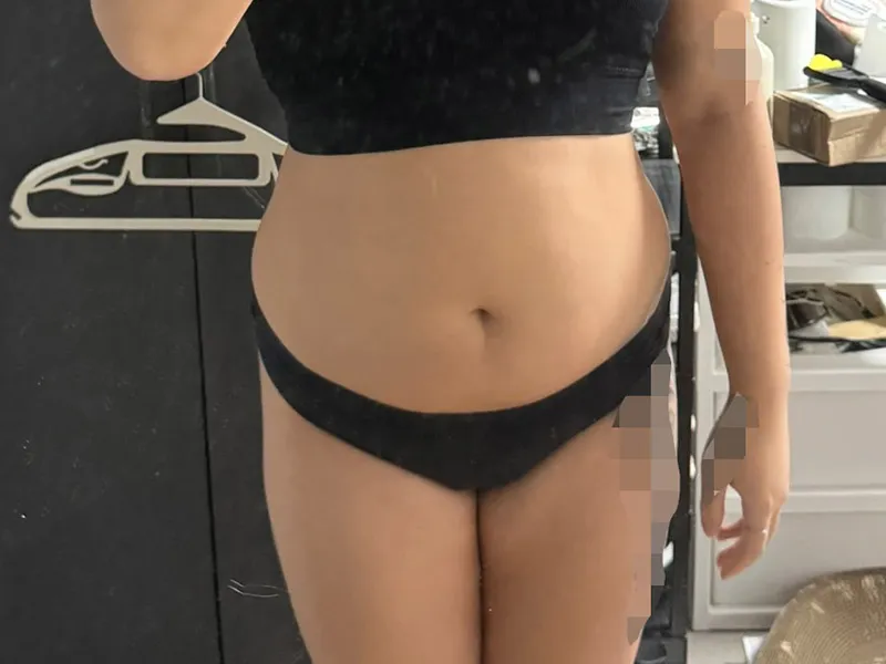 Abdomen liposuction before
