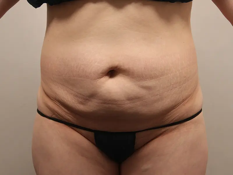 Tummy tuck before
