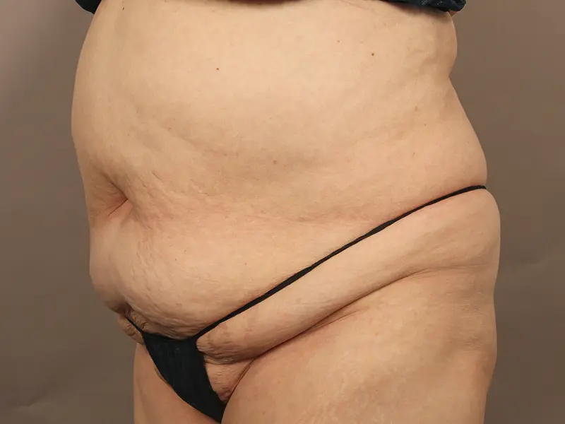 Tummy tuck before
